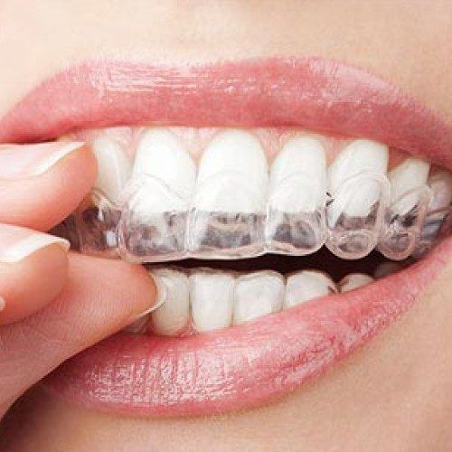 Invisalign Prices In Abu Dhabi: A Detailed Breakdown Of Expenses